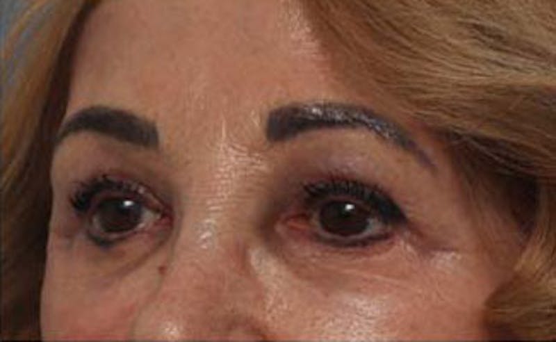 Eyelid Surgery Before & After Gallery - Patient 139797 - Image 6