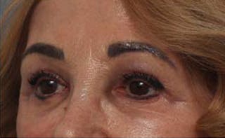 Eyelid Surgery Before & After Gallery - Patient 139797 - Image 6