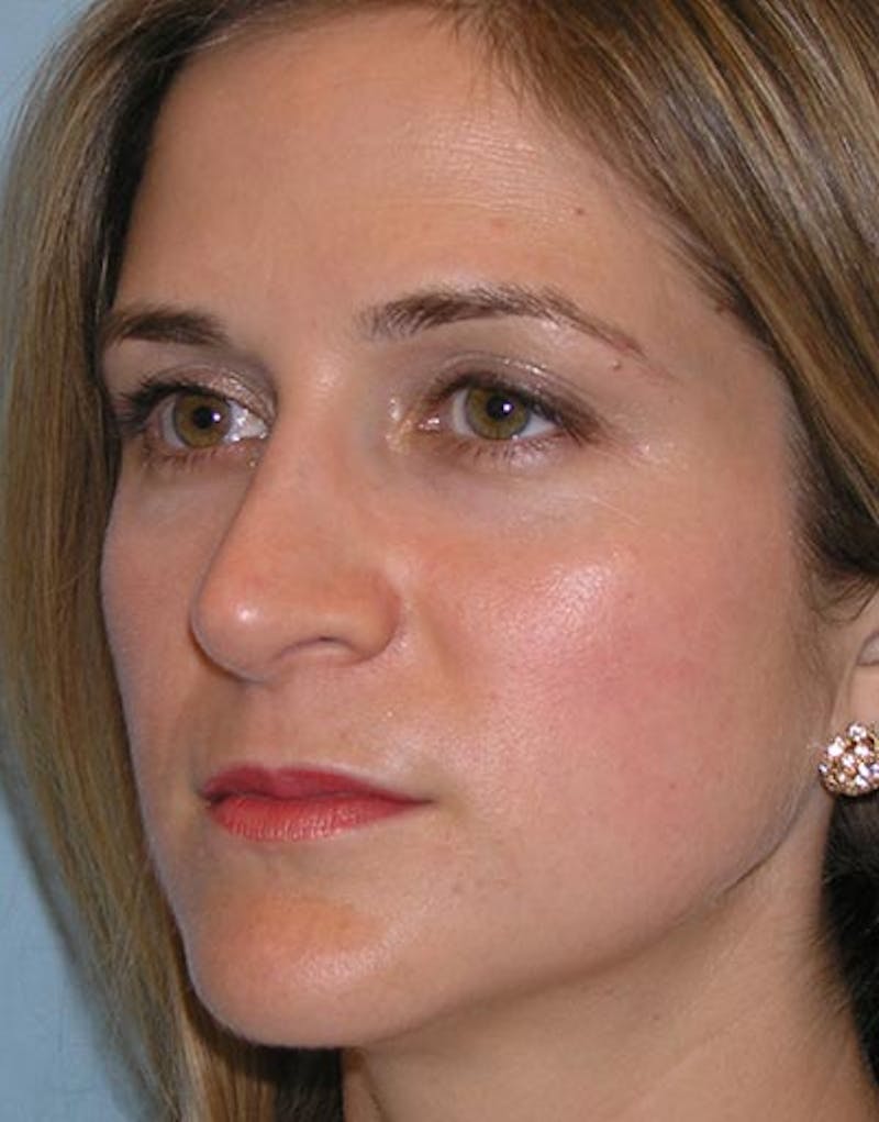 Rhinoplasty Before & After Gallery - Patient 308774 - Image 6