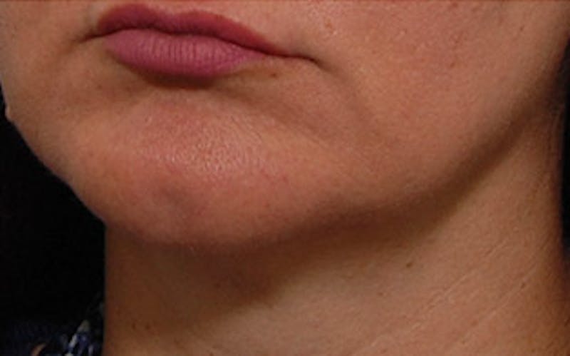 Chin Surgery Before & After Gallery - Patient 134570 - Image 4