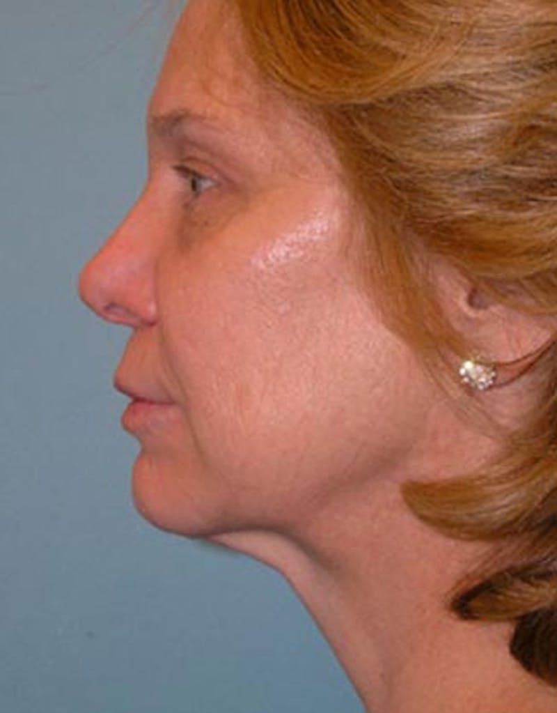 Jawline Contouring Before & After Gallery - Patient 196882 - Image 2