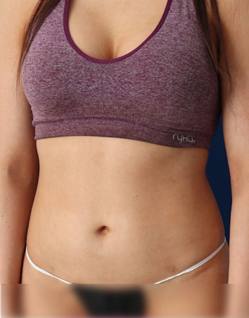 Liposuction (Body) Before & After Gallery - Patient 255887 - Image 6