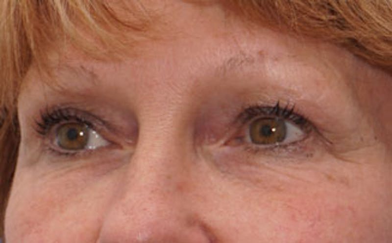BOTOX Before & After Gallery - Patient 196776 - Image 6