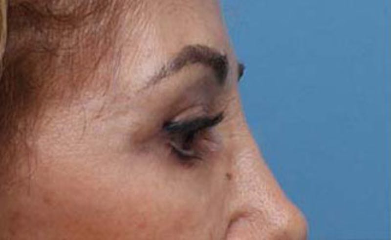 Eyelid Surgery Before & After Gallery - Patient 139797 - Image 7