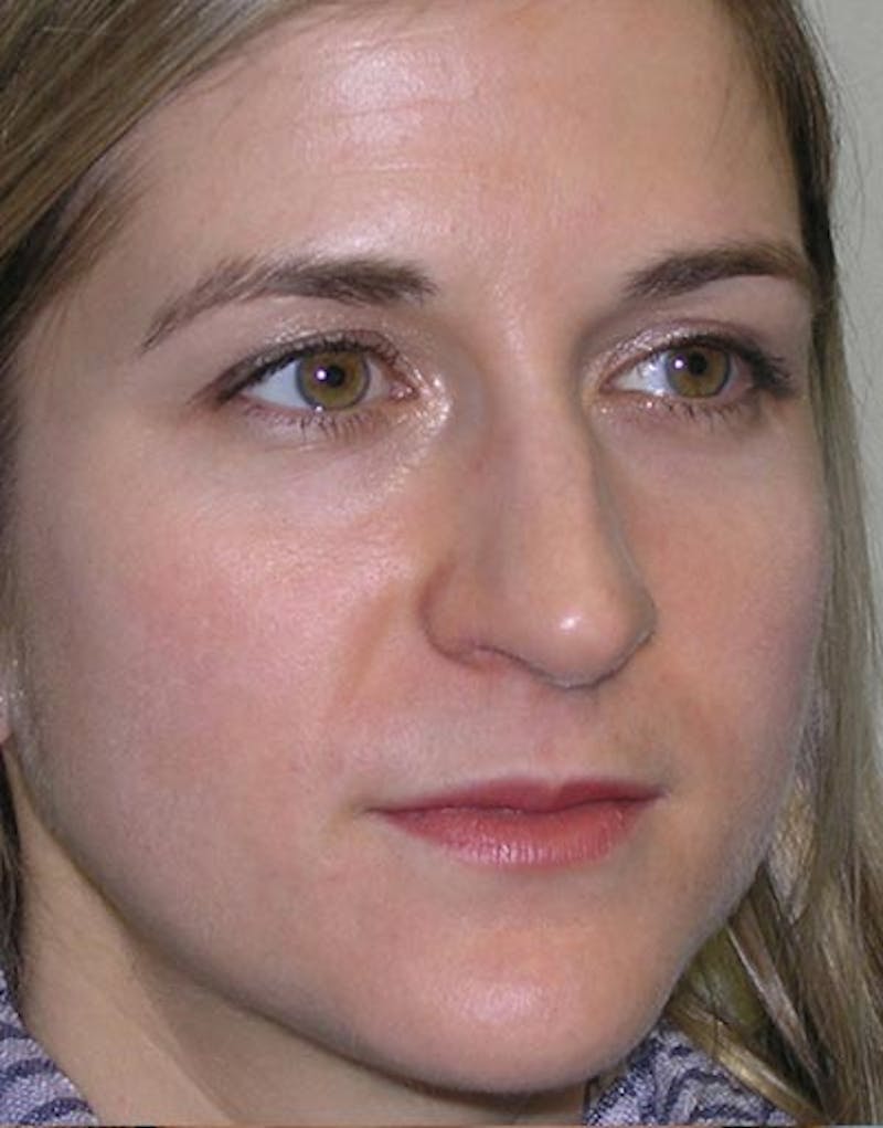 Rhinoplasty Before & After Gallery - Patient 308774 - Image 7