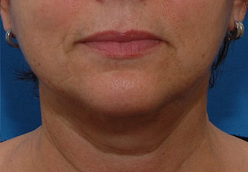 Facelift Before & After Gallery - Patient 177954 - Image 8