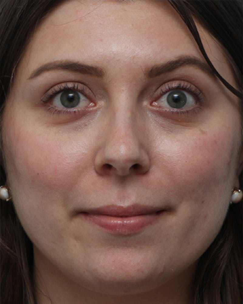 Fillers Before & After Gallery - Patient 133084 - Image 1