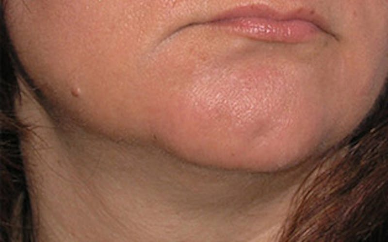 Chin Surgery Before & After Gallery - Patient 134570 - Image 5