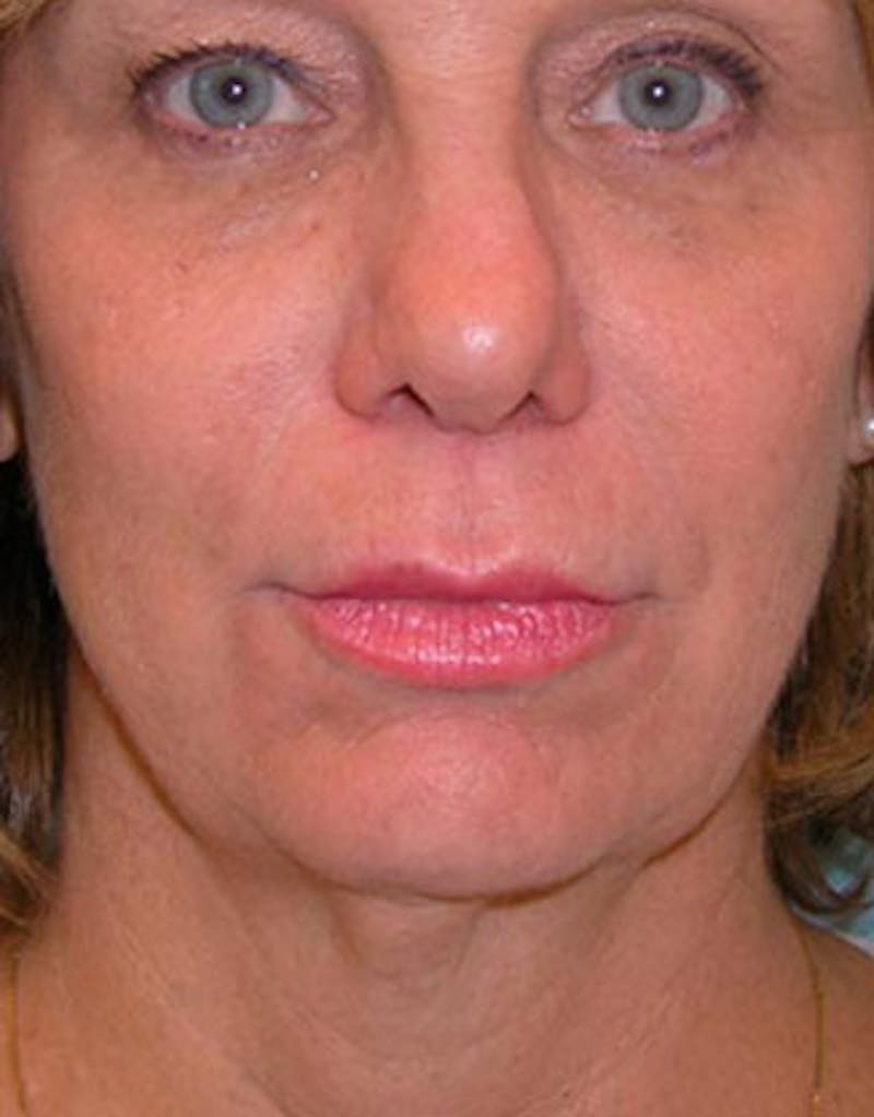 Jawline Contouring Before & After Gallery - Patient 196882 - Image 3