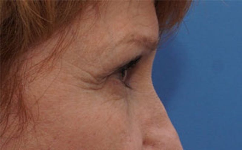 BOTOX Before & After Gallery - Patient 196776 - Image 7