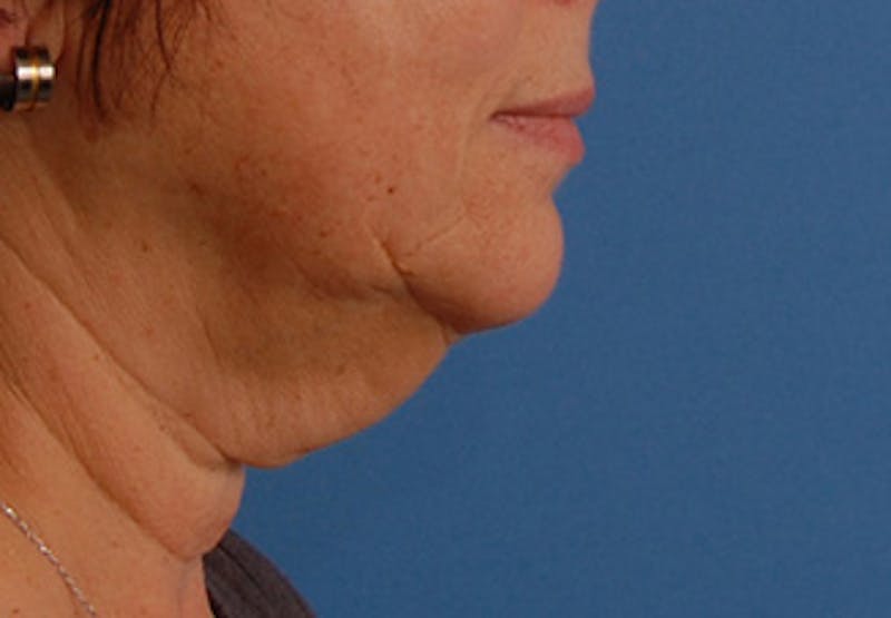 Facelift Before & After Gallery - Patient 177954 - Image 9