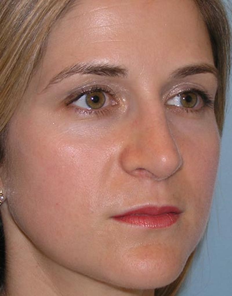 Rhinoplasty Before & After Gallery - Patient 308774 - Image 8