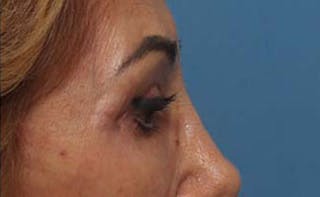 Eyelid Surgery Before & After Gallery - Patient 139797 - Image 8