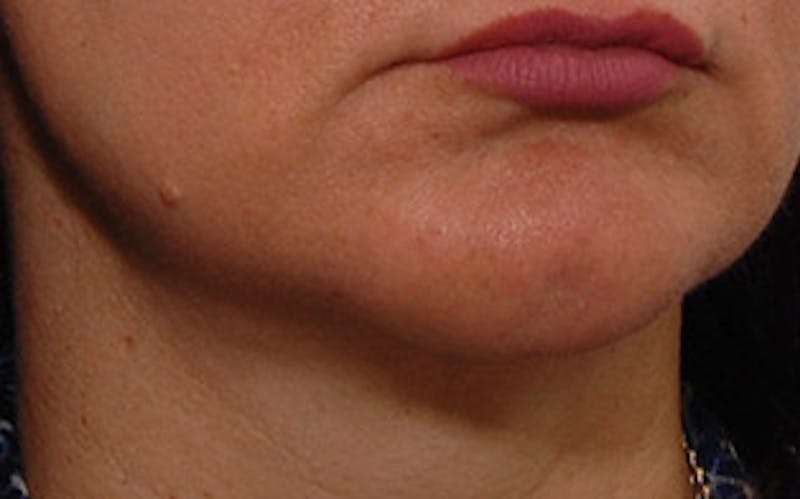 Chin Surgery Before & After Gallery - Patient 134570 - Image 6