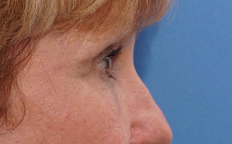 BOTOX Before & After Gallery - Patient 196776 - Image 8