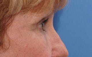 BOTOX Before & After Gallery - Patient 196776 - Image 8