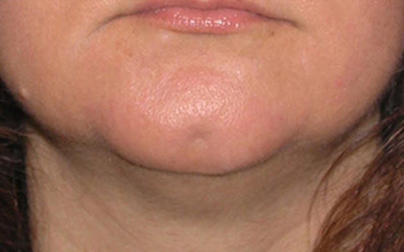 Chin Surgery Before & After Gallery - Patient 134570 - Image 7