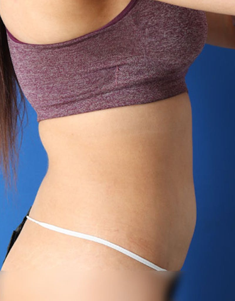Liposuction (Body) Before & After Gallery - Patient 255887 - Image 8