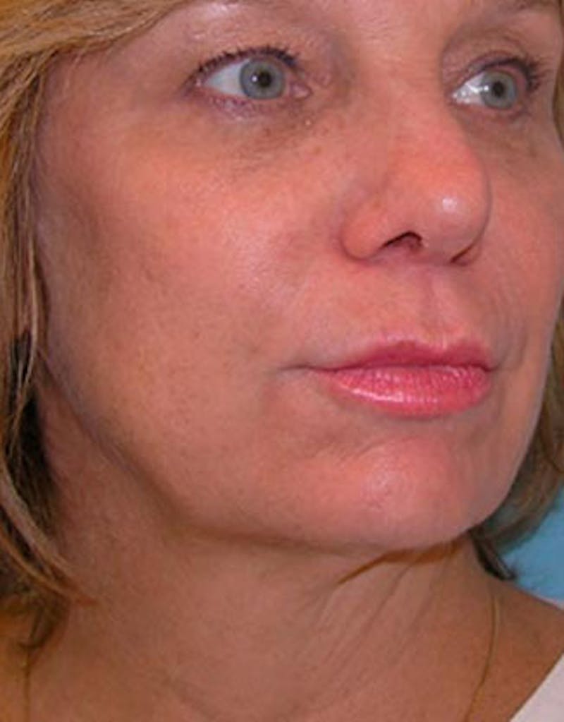 Jawline Contouring Before & After Gallery - Patient 196882 - Image 5