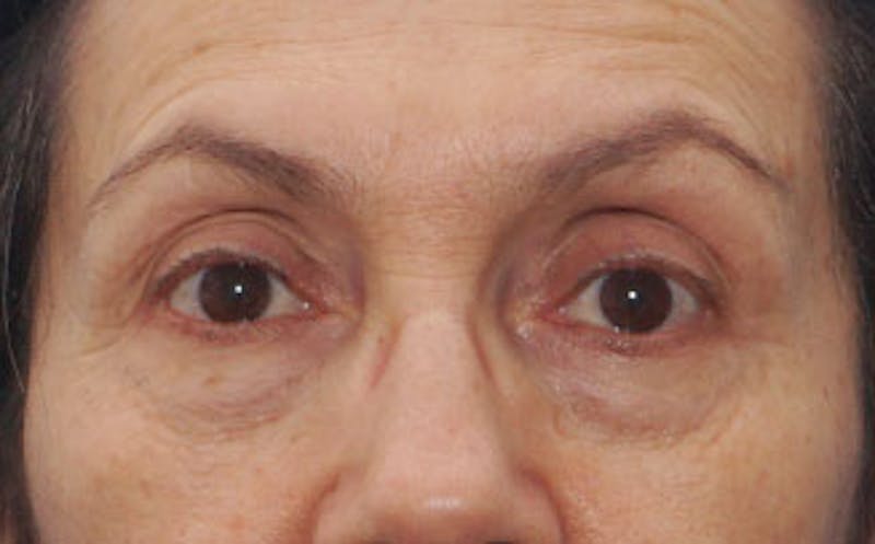 BOTOX Before & After Gallery - Patient 297943 - Image 1