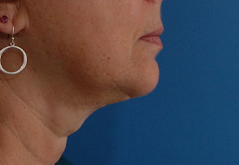 Facelift Before & After Gallery - Patient 177954 - Image 10