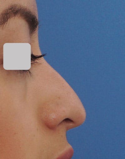 Favorite Ethnic Rhinoplasty Before & After Gallery - Patient 491007 - Image 1