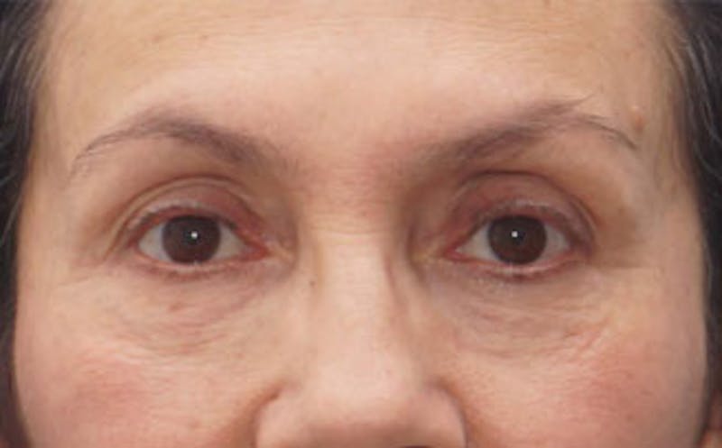 BOTOX Before & After Gallery - Patient 297943 - Image 2
