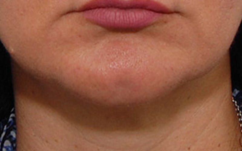 Chin Surgery Before & After Gallery - Patient 134570 - Image 8