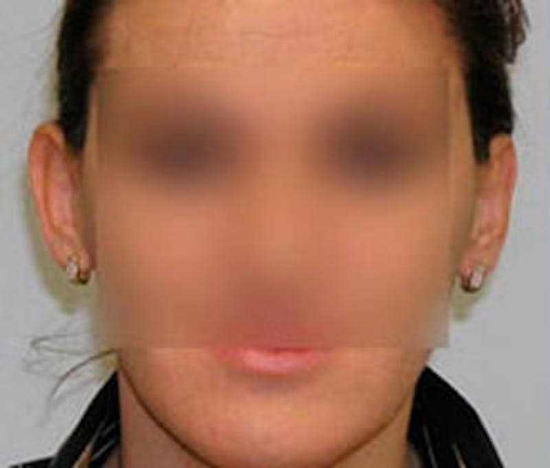 Ear Surgery Before & After Gallery - Patient 179692 - Image 1