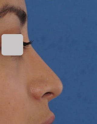 Favorite Ethnic Rhinoplasty Before & After Gallery - Patient 491007 - Image 2