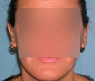 Ear Surgery Before & After Gallery - Patient 179692 - Image 2