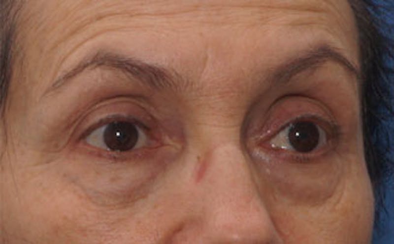 BOTOX Before & After Gallery - Patient 297943 - Image 3