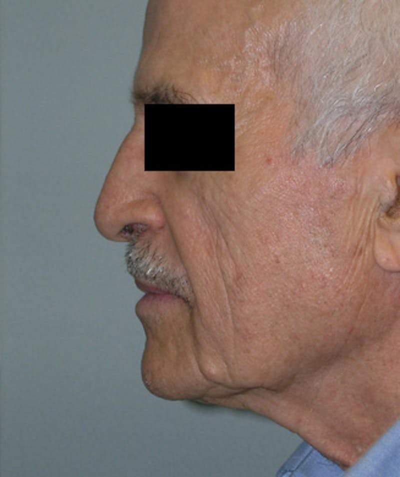 Facelift Before & After Gallery - Patient 217131 - Image 1