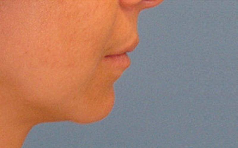 Chin Surgery Before & After Gallery - Patient 400389 - Image 1