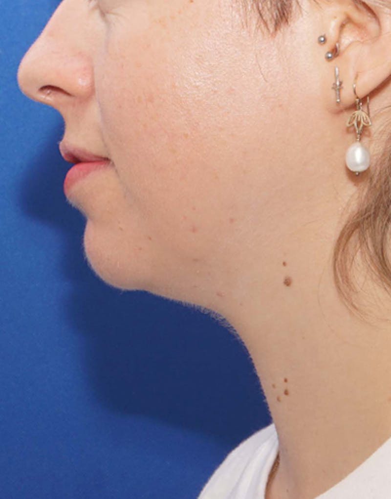 Jawline Contouring Before & After Gallery - Patient 422220 - Image 1