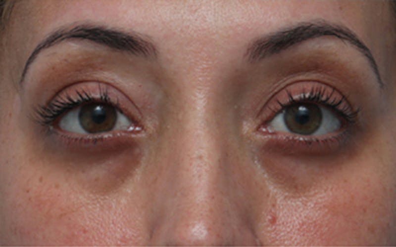 Patient eP8HgBTkQn2hxxOVAEVY6g - Fillers Before & After Photos