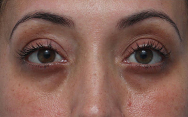 Fillers Before & After Gallery - Patient 408725 - Image 1