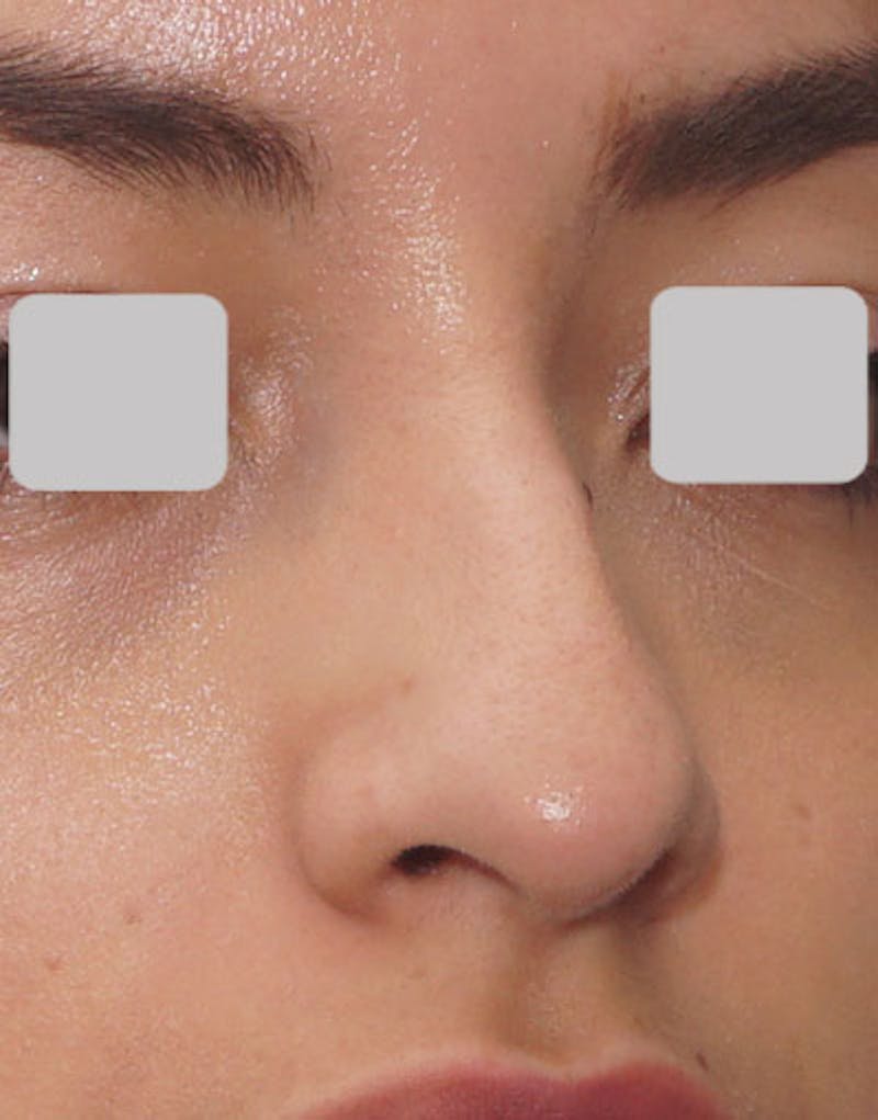 Rhinoplasty Before & After Gallery - Patient 247789 - Image 3