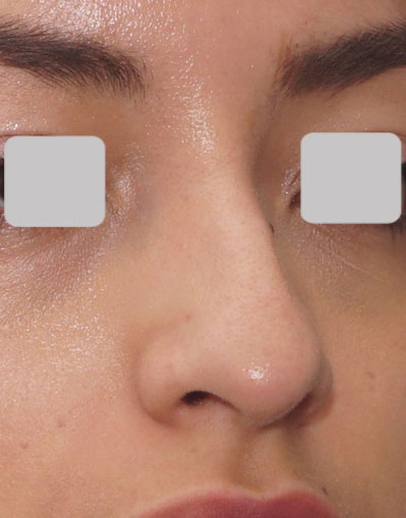 Rhinoplasty  Before & After Gallery - Patient 365447 - Image 3