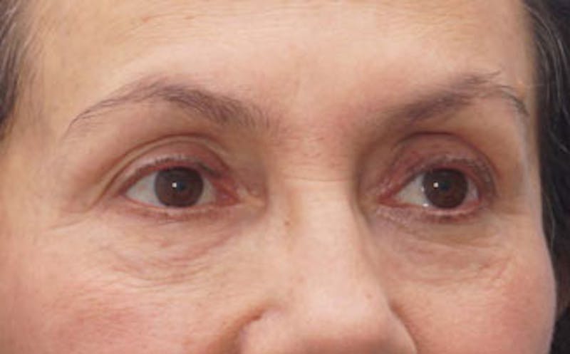 BOTOX Before & After Gallery - Patient 297943 - Image 4