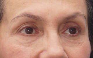 BOTOX Before & After Gallery - Patient 297943 - Image 4