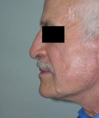 Facelift Before & After Gallery - Patient 217131 - Image 2