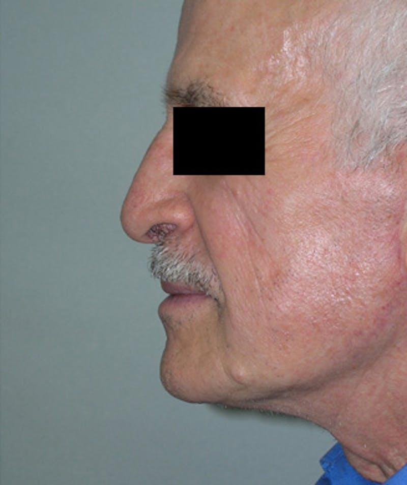 Facelift Before & After Gallery - Patient 217131 - Image 2