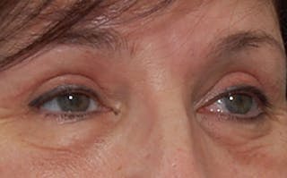 Eyelid Surgery Before & After Gallery - Patient 399163 - Image 4