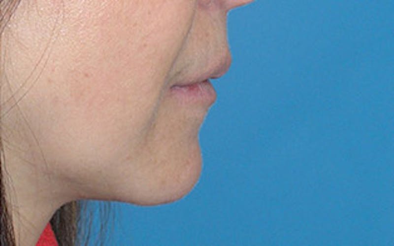 Chin Surgery Before & After Gallery - Patient 400389 - Image 2