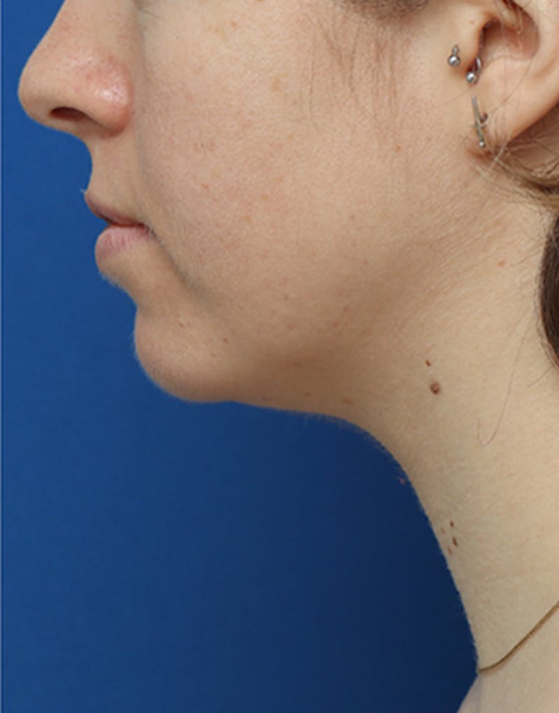 Jawline Contouring Before & After Gallery - Patient 422220 - Image 2