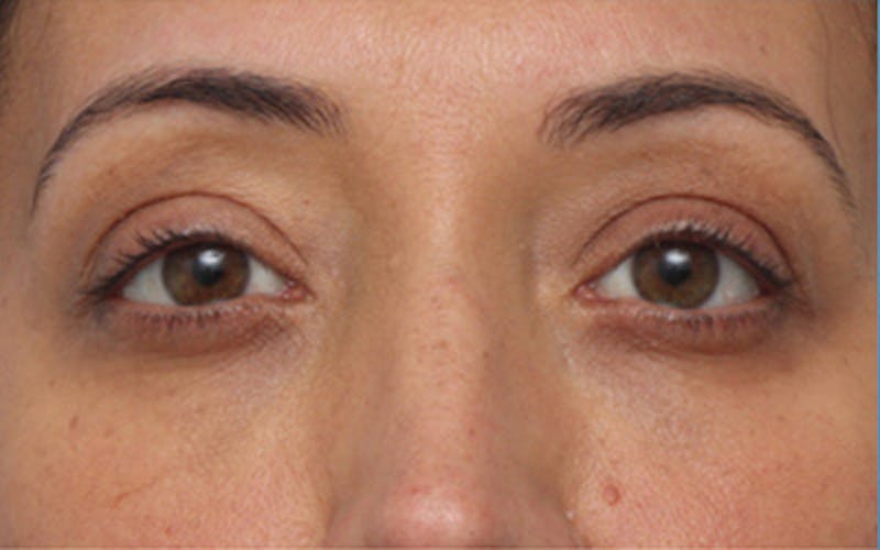 Fillers Before & After Gallery - Patient 408725 - Image 2