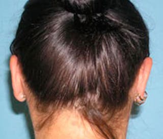 Ear Surgery Before & After Gallery - Patient 179692 - Image 4