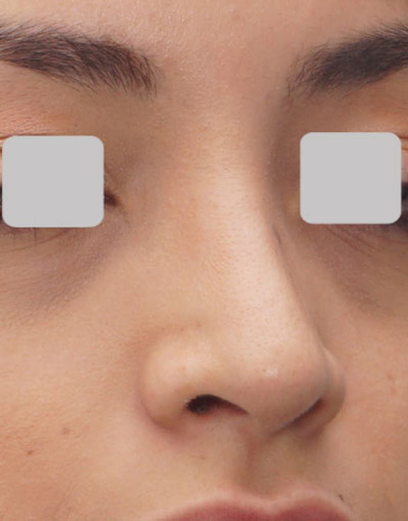 Rhinoplasty  Before & After Gallery - Patient 365447 - Image 4