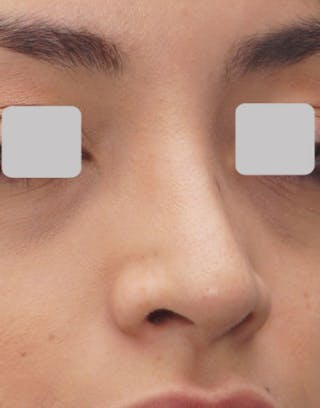 Favorite Ethnic Rhinoplasty Before & After Gallery - Patient 491007 - Image 4